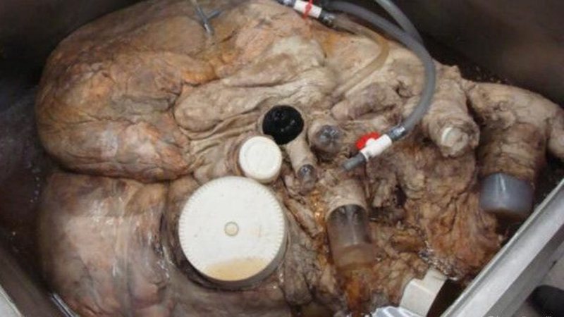 The biggest heart ever recorded by science -