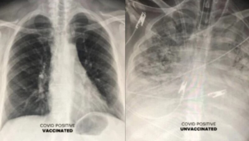 An American doctor shows a radiograph of the effect of Covid on the vaccinator's lungs