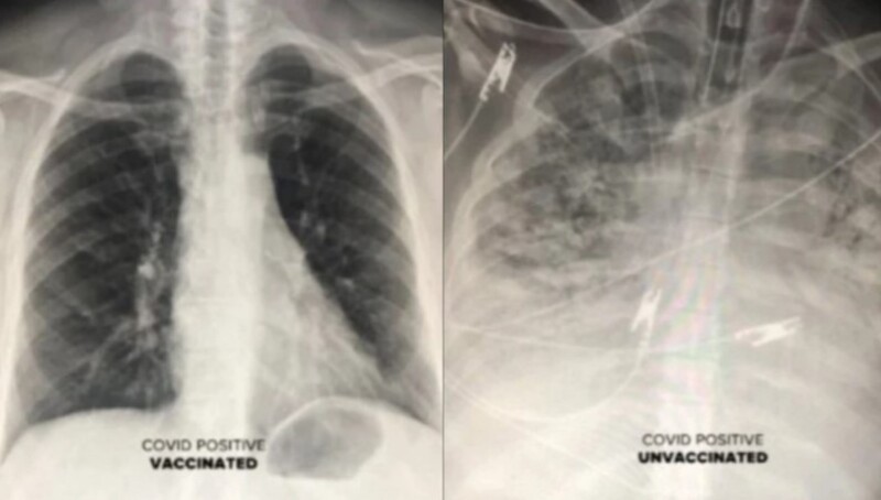 An American doctor shows a radiograph of the effect of Covid on the vaccinator’s lungs