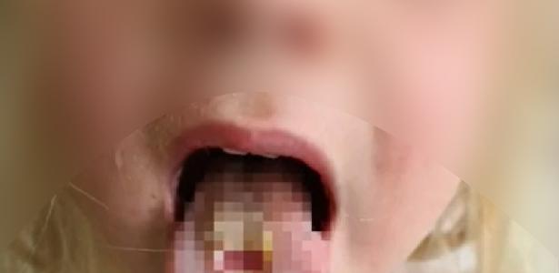 Girl suffers tongue burn from eating sour candy