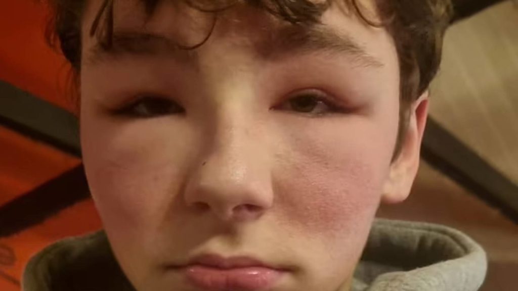 Teen suffers 'allergic reaction' after using virtual reality glasses