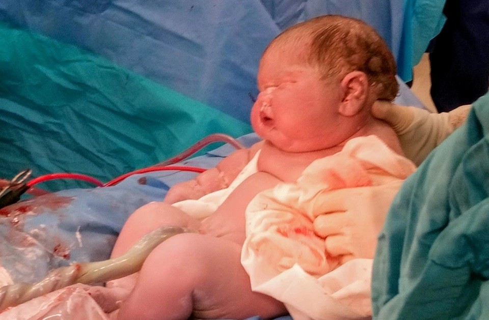 Alpha was born weighing less than 6 kg because her mother had gestational diabetes (Photo: Reproduction / Sun)