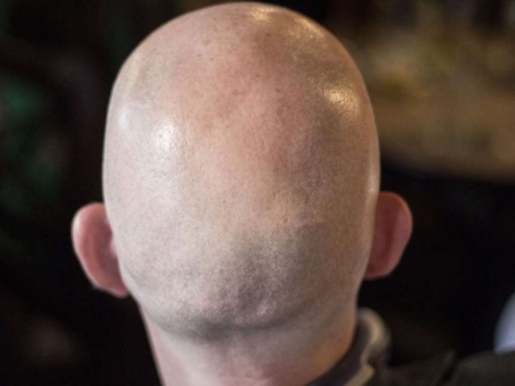British court ruling a man as 'bald' is considered sexual harassment;  understand
