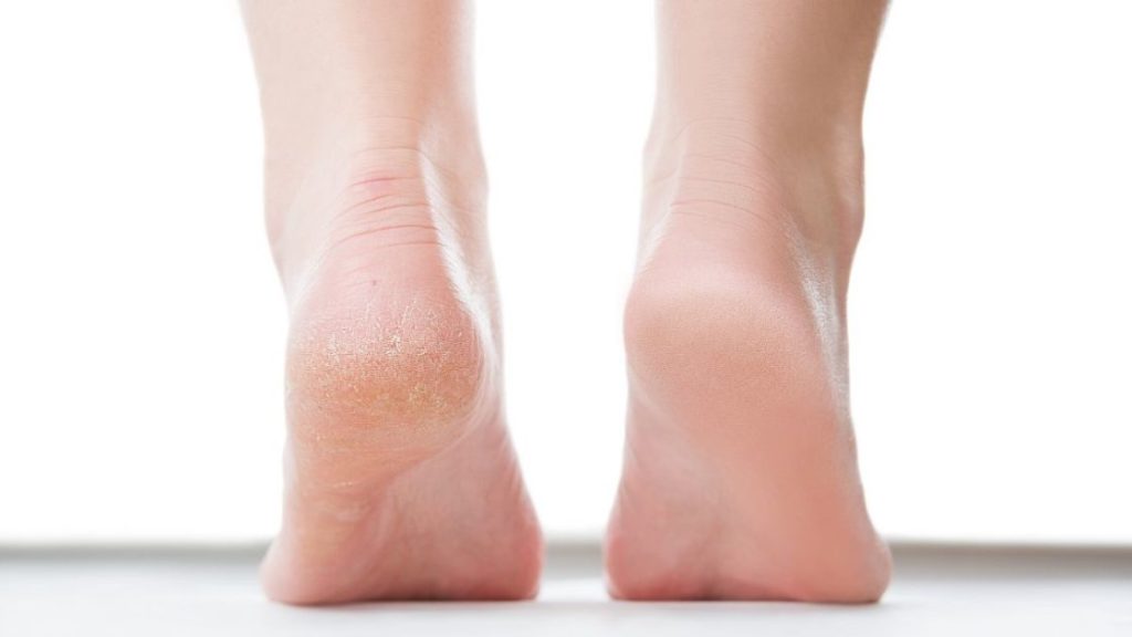 Symptoms of diabetes can start in the feet