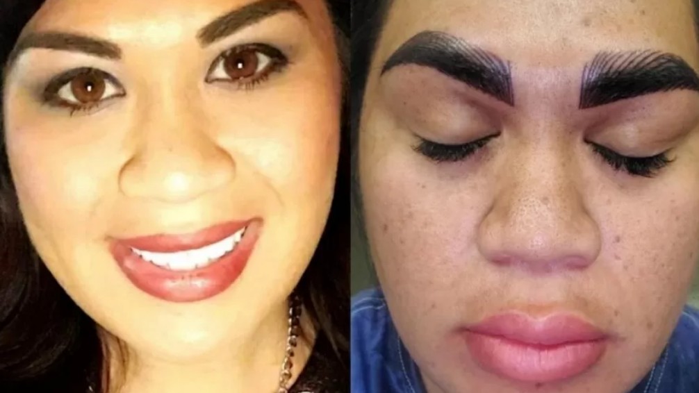 Woman says 'terrifying' after she paid R$1,700 for eyebrow surgery