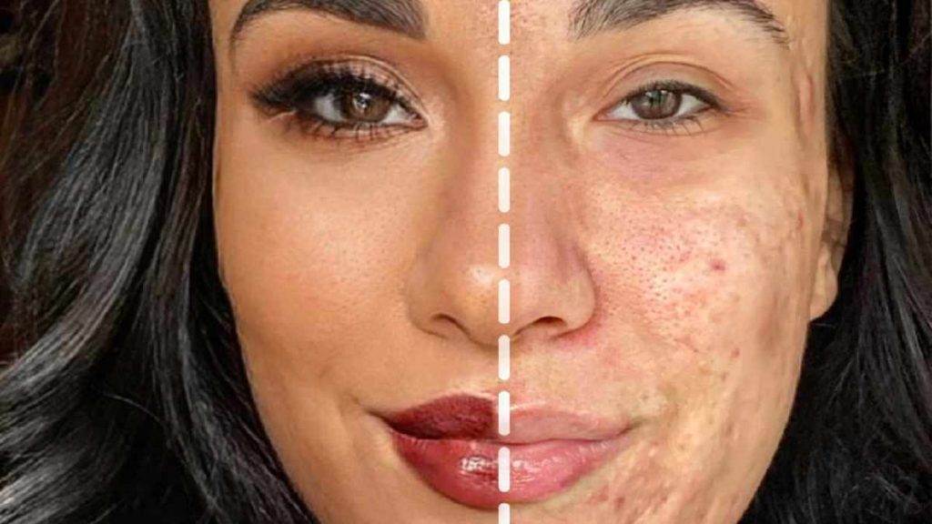 The influencer shocks the web by showing off half makeup and half acne face