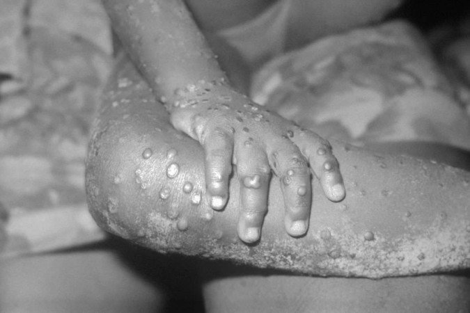 Doença é marcada pelo aparecimento de nódulos na pele -  (crédito: CDC)