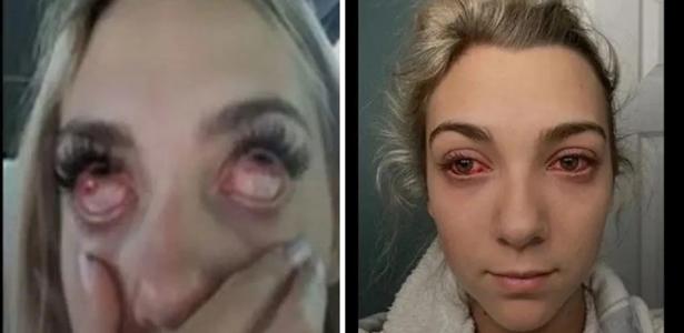 The young man had “zombie eyes” due to his eyelash connections.  See Risks – 08/31/2022