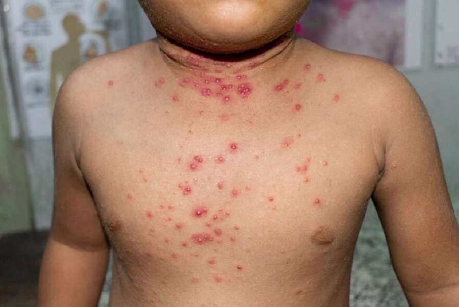 Monkeypox affects children and two cases of ST . have been reported