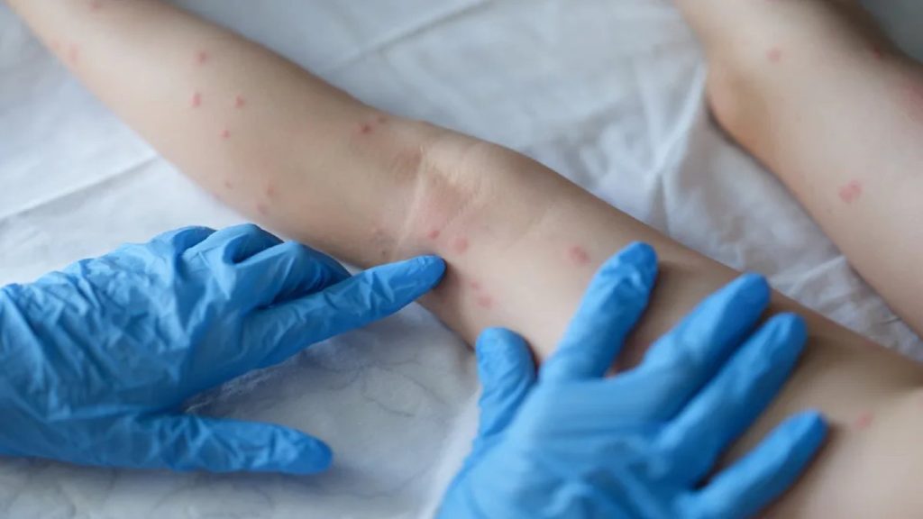 Second case of monkeypox confirmed in Lajedo