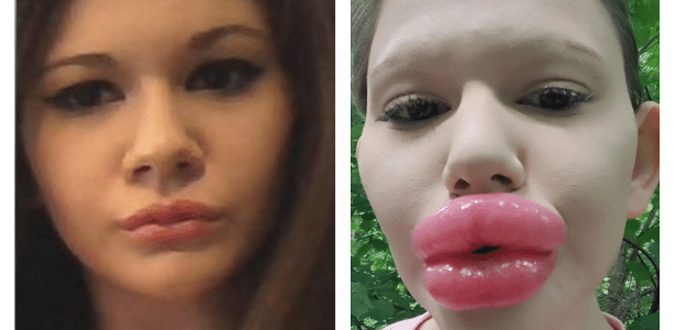 The woman who is proud of the 'biggest lips in the world' wants her breasts enlarged