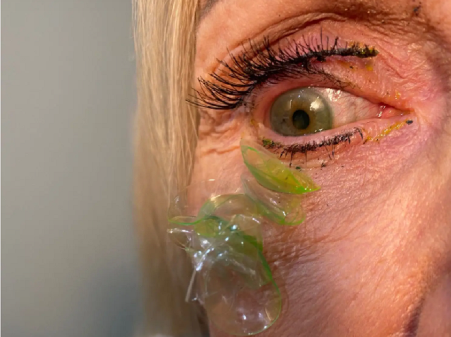 A video that removes 23 lenses from the patient's eye, a virus spreads
