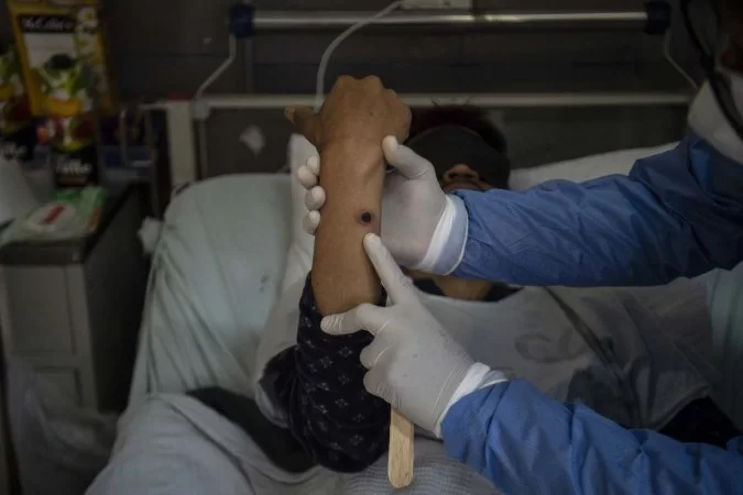 Study investigates transmission of smallpox from monkeys through contaminated surfaces
